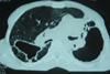 Bilateral_fibrosis_and_pleural_thickening_in_an_infection_with_non-tuberculosis_mycobacteria_(view_from_above)