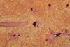 Cirrhosis_liver