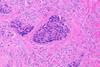 Histopathology_of_colorectal_adenocarcinoma_with_lymphatic_invasion