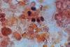 Pneumococcus_in_Gram-Stained_BAL_Sample
