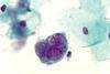 Herpes_on_Pap_test,_original