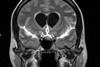 FLAIR_MRI_of_meningitis