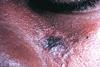 Discoid_lupus_erythematosus
