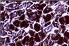 Histopathology_of_Malignant_melanoma