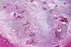Acute_appendicitis,_low_mag.2