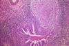 Bronchocentric_tuberculosis_Case_201_(6545170087)