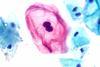 HPV-Infected_Squamous_Cell_(Koilocyte)_of_the_Cervix_(44001403165)