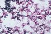 Cryptococcosis_-_Mucicarmine_stain_(5280759612)