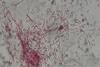 Gram_negative_rods_(GNRs)_of_Pseudomonas_aeruginosa_in_Gram_staining_of_BAL