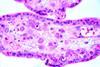 Cytomegalovirus_(CMV)_Placentitis