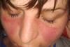 Butterfly erythema in systemic lupus