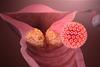 HPV_causing_cervical_cancer