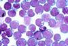 Epstein-barr_virus_(ebv)