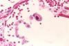 Cytomegalovirus_01