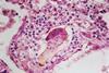 Schistosomiasis_(13383125494)