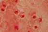 Gram_negative_coccobacilli_of_Acinetobacter_in_bronchoalveolar_lavage_(BAL)_Gram_staining (1)