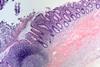 Acute appendicitis histology image