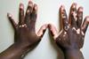 Vitiligo2