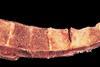 Tuberculosis_of_spinal_column_(6539943165)