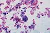 Cytomegalovirus_infection_(3786798300)