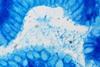 Helicobacter_pylori,_Gastric_Biopsy,_Giemsa_Stain_(5517582111)