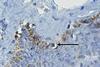 Human_papilloma_virus_(HPV)_1618_E6_staining_in_normal_and_ductal_carcinoma_in_situ_(DCIS)_breast_cancer_specimens