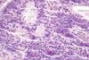 800px-Tumour_infiltrating_lymphocytes_in_colorectal_carcinoma_-_very_high_mag