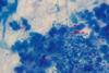Mycobacterium_tuberculosis_in_Ziehl-Neelsen_stained_smear_of_sputum (1)