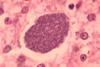 Histopathology_of_malaria_exoerythrocytic_forms_in_liver_07G0024_lores