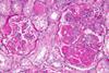 Diffuse_proliferative_lupus_nephritis_-a-_very_high_mag