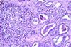 800px-Prostate_cancer_(1)