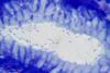 Helicobacter_pylori_in_a_case_of_gastritis