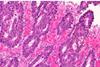 Micrograph_of_poorly_differentiated_colorectal_carcinoma