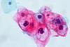 CIN_1-HPV_on_ThinPrep