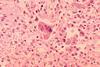 Measles_pneumonia_-_Histopathology