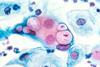 800px-Pap_smear_showing_clamydia_in_the_vacuoles_500x_H&E