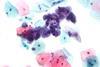 Herpes_simplex_virus_pap_test_2