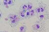 Cerebrospinal_fluid_differential_in_bacterial_meningitis_-_Wright-Giemsa_stain (1)