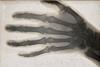 The_bones_of_a_hand,_viewed_through_x-ray;_possibly_with_a_n_Wellcome_V0029533