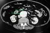 Contrast-enhanced_CT_scan_demonstrating_abdominal_aortic_aneurysm (1)