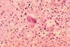 Measles_pneumonia_-_Histopathology (2)