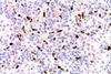 LANA-1_immunostain_in_a_Kaposi_sarcoma_in_a_patient_with_HHV8-associated_MCD