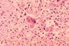 Measles_pneumonia_-_Histopathology