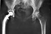 Hip_replacement_Image_3684-PH