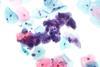 Herpes_simplex_virus_pap_test_2