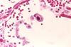 Cytomegalovirus_01