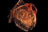 Smallpox_CAM