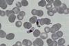 P.falciparum-gametocytes