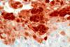 Low-Grade_Papillary_Urothelial_Tumor_of_Bladder_with_Herpes_Simplex_Virus_Infection_(8534832864)