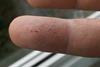 Eczema_versus_Fingerprints_2009